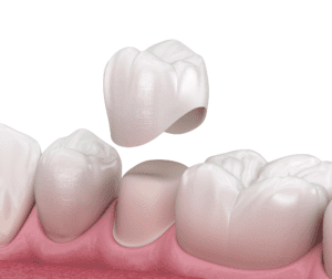 Dental Crowns Smiles for Life Family Dentistry dentist in las vegas nevada Dr. John M. Quinn, Dr. Joseph Wills, or Dr. Paul Leatham