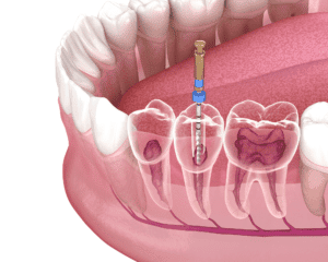 Root Canal Treatment Smiles for Life Family Dentistry dentist in las vegas nevada Dr. John M. Quinn, Dr. Joseph Wills, or Dr. Paul Leatham