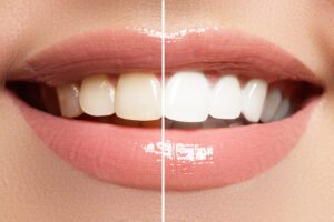 ZOOM! Teeth Whitening Smiles for Life Family Dentistry dentist in las vegas nevada Dr. John M. Quinn, Dr. Joseph Wills, or Dr. Paul Leatham