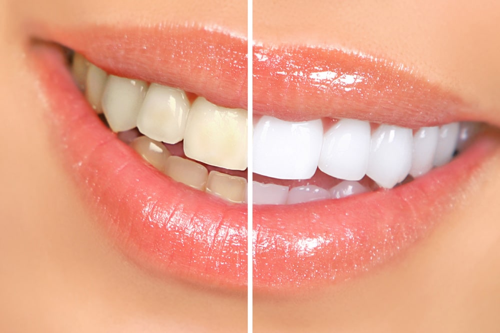 Whitening